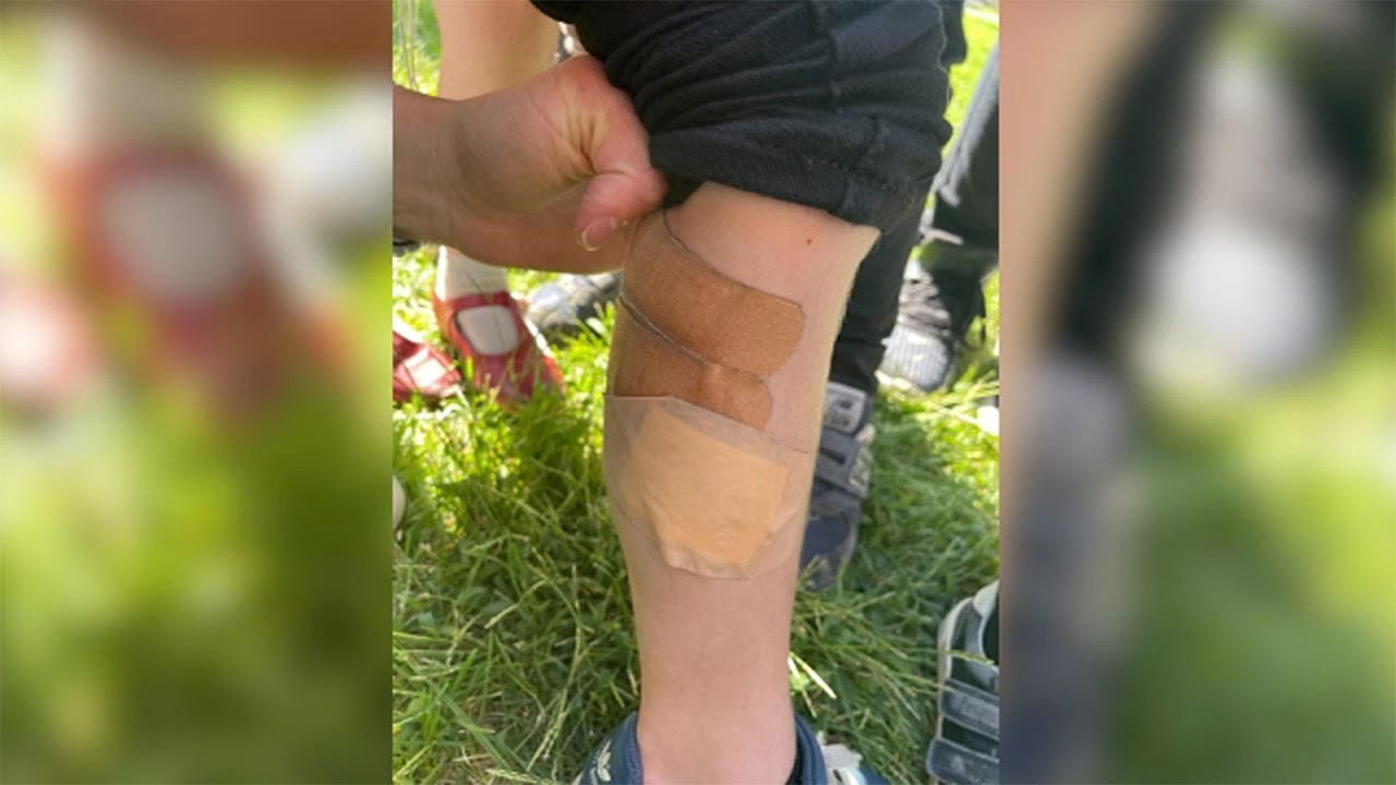 NJ police investigating after multiple kids bitten by fox