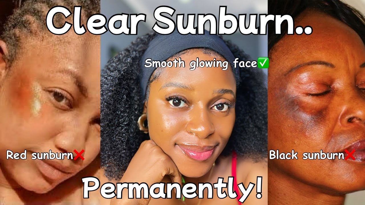 Best brightening face creams for SUNBURN✅| how to clear sunburn permanently 