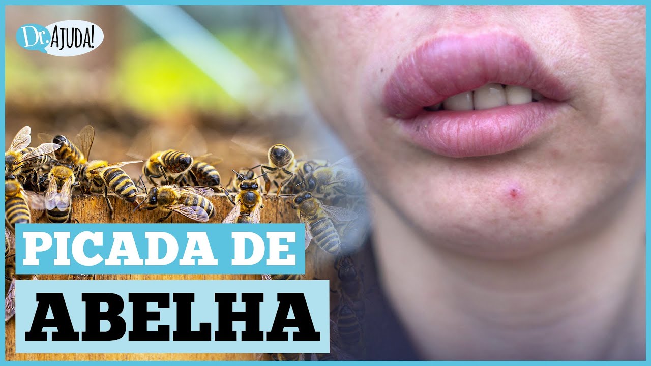 VOCÊ REALMENTE SABE O QUE FAZER NA PICADA DE ABELHA? COMO RECONHECER CASOS GRAVES E COMO PREVENIR?
