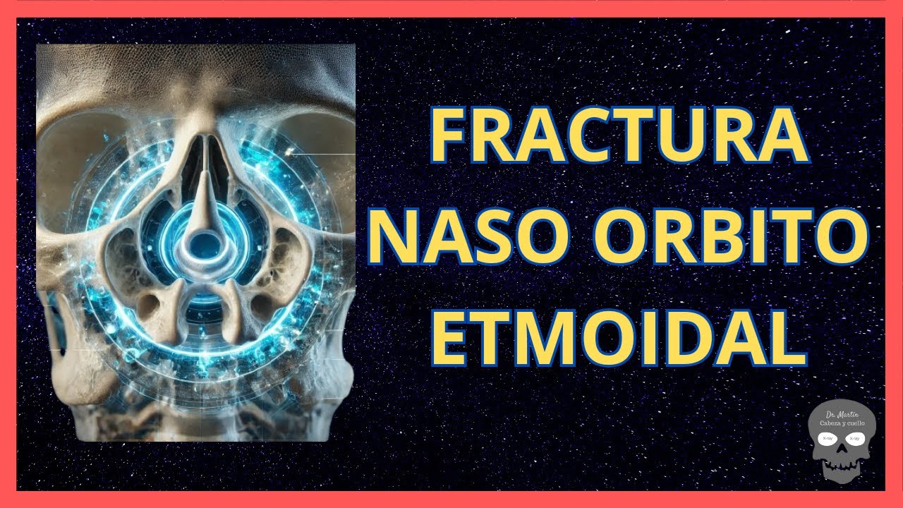 🩻 Fractura Naso Órbito Etmoidal: Diagnóstico en Tomografía 🔍