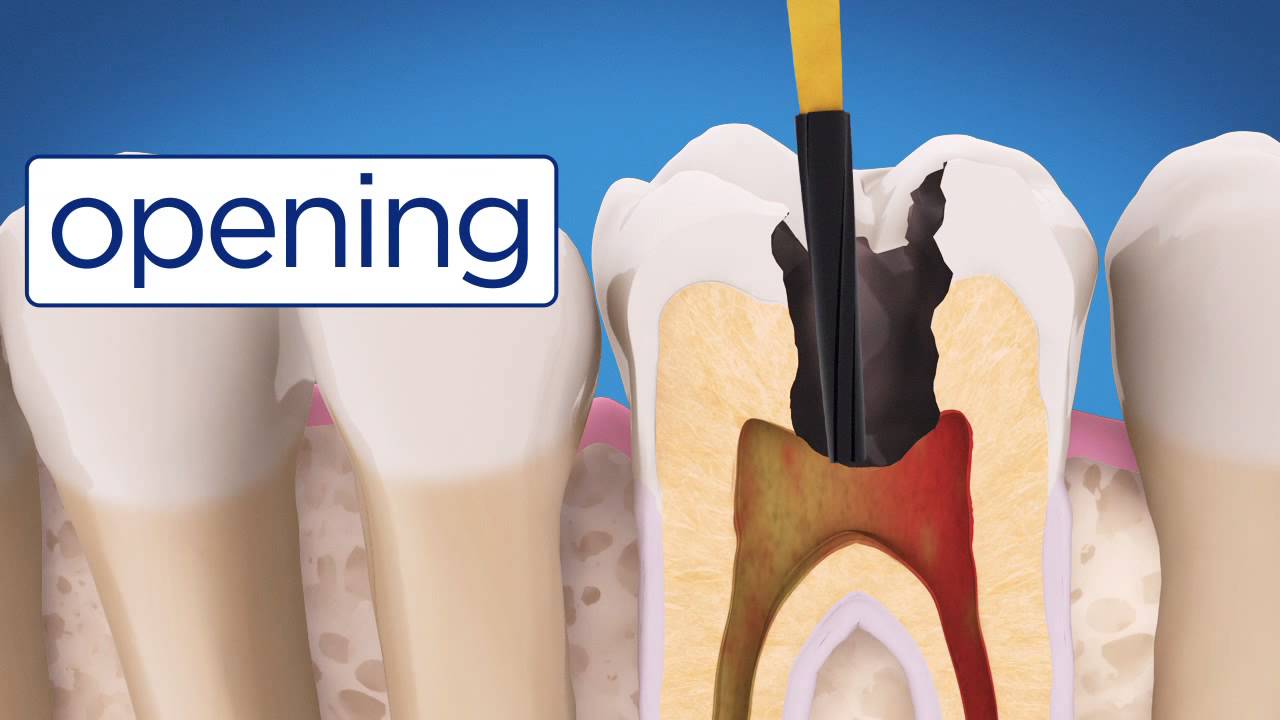 AAE Root Canal Treatment Video
