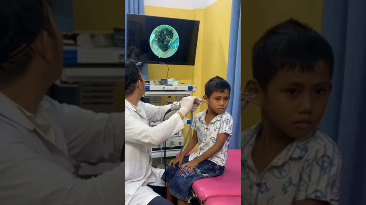 Doctor Removes Giant Earwax Blockage! 😱👂 #ENT #EarCare #Doctor