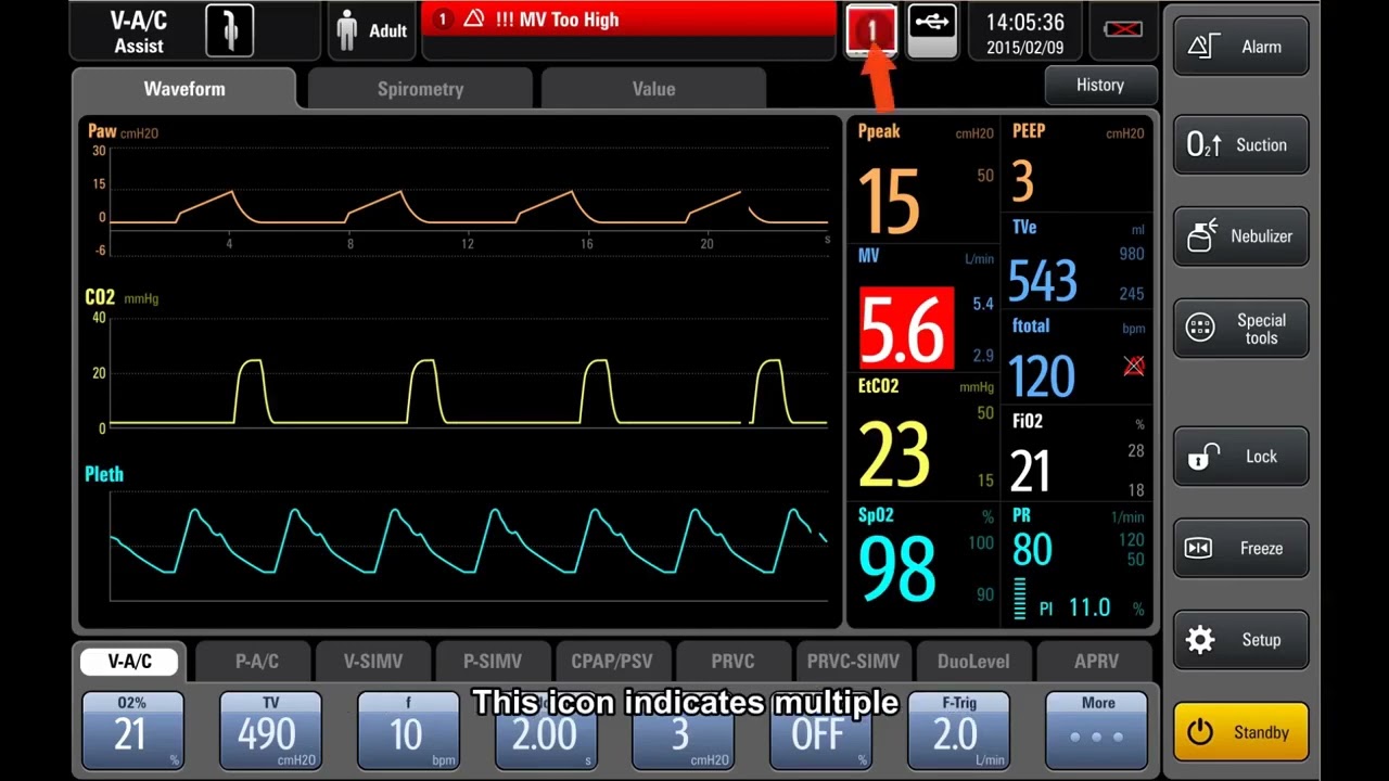 operating Mindray ventilator