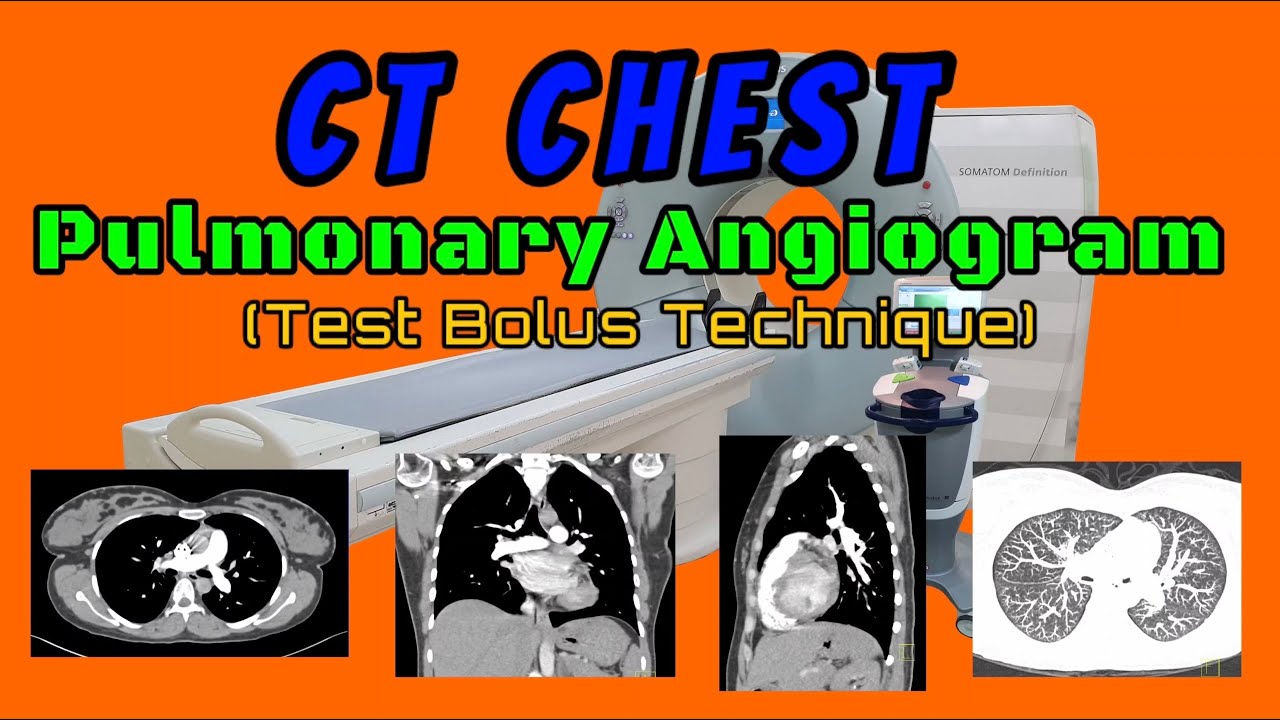 CT Chest Pulmonary Angiogram (Test Bolus Technique)