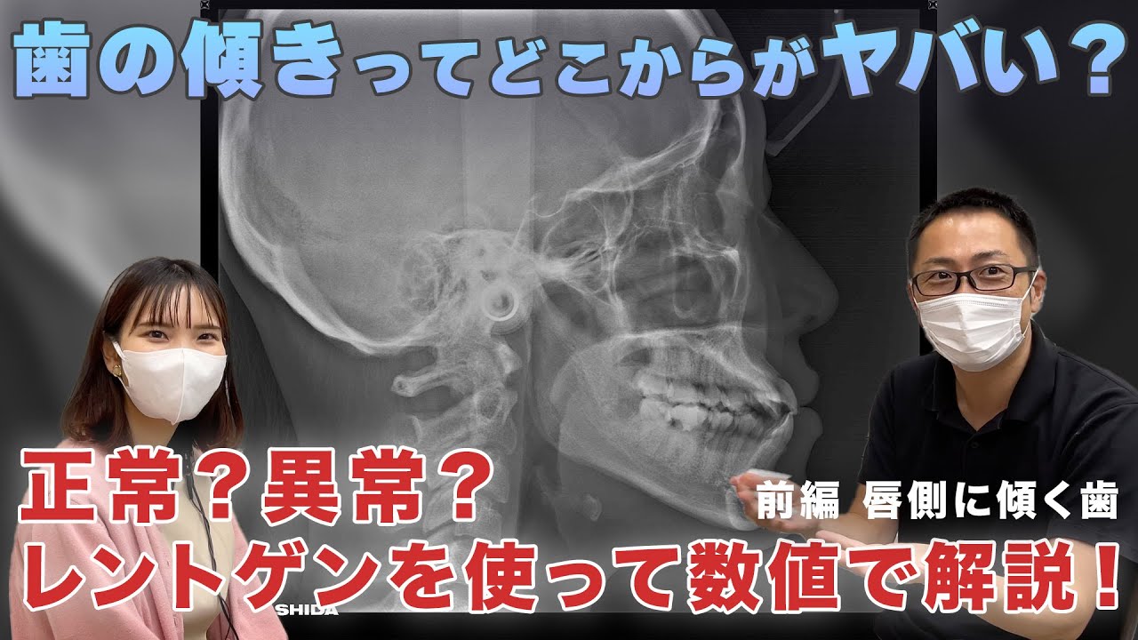 【前編】歯の傾きってどこまでが正常？数値でバチっと解説します！【唇側傾斜】
