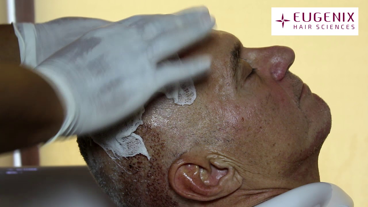 How to wash your head after getting a hair transplant