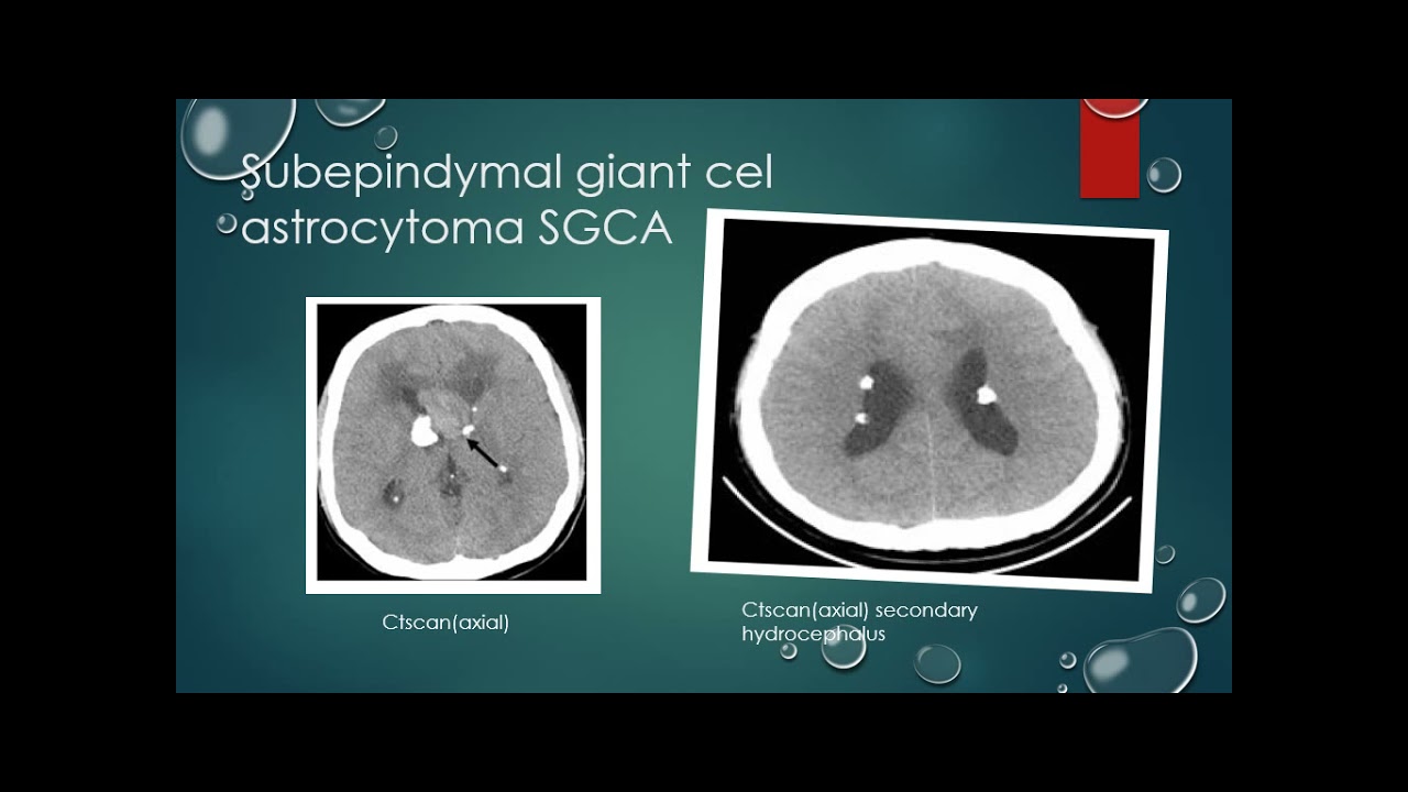 Systemic manifestations of tuberous sclerosis