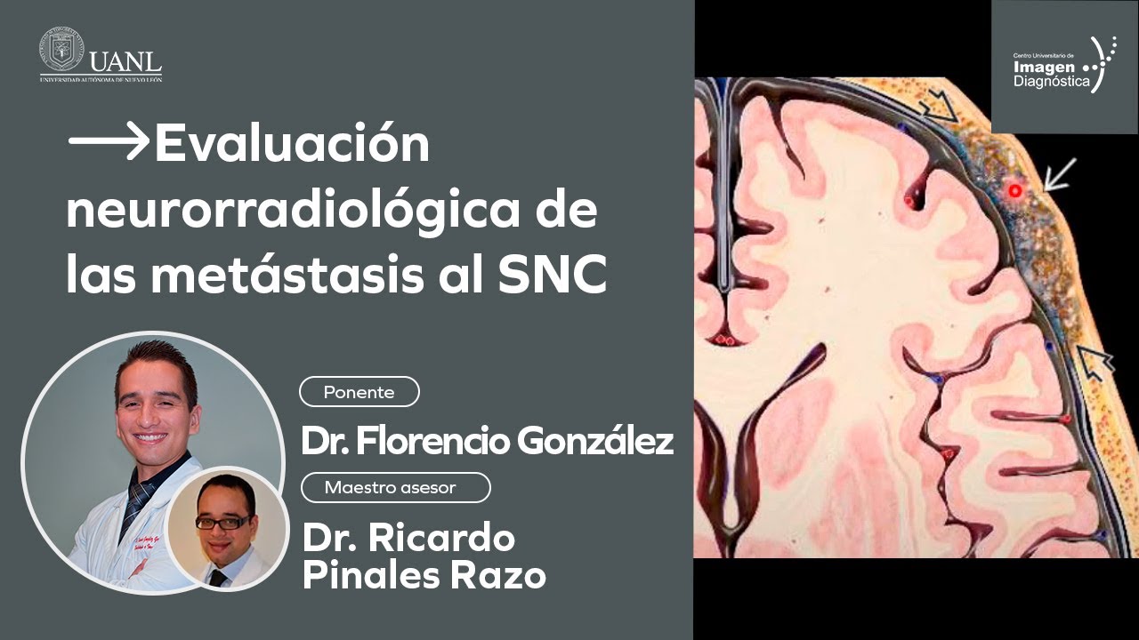 Evaluación neurorradiológica de las metástasis al SNC por el Dr. Florencio González.