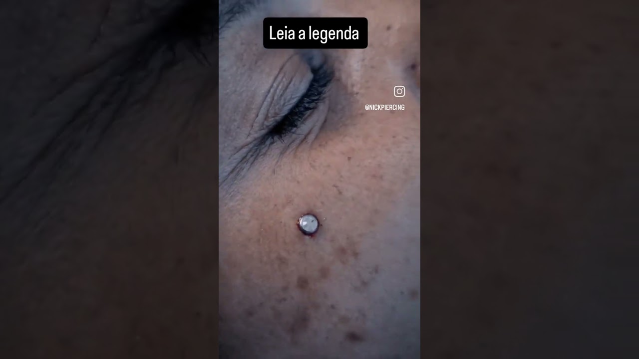 Microdermal