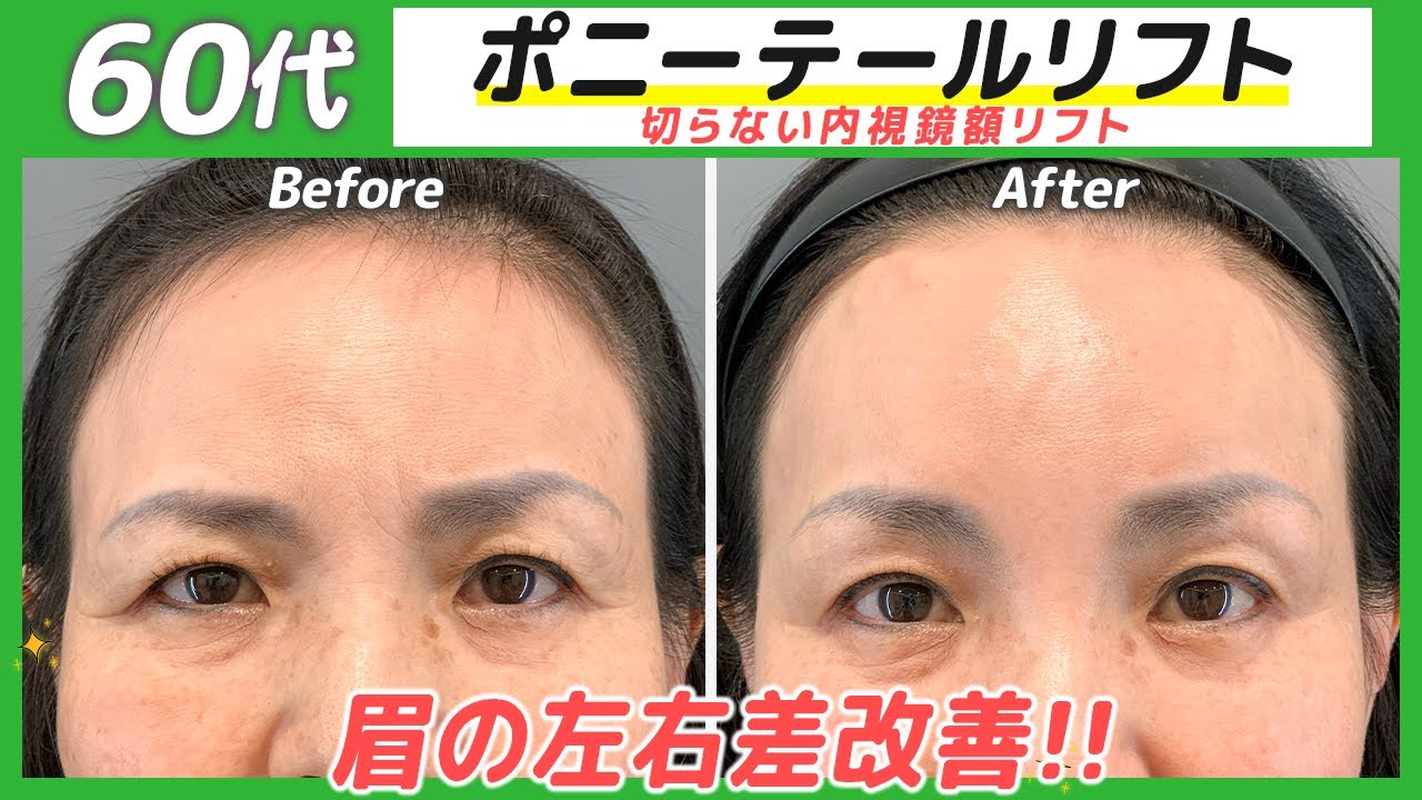 30年前に戻った✨ダウンタイムが少ないポニーテールリフト💡【内視鏡前額リフト】