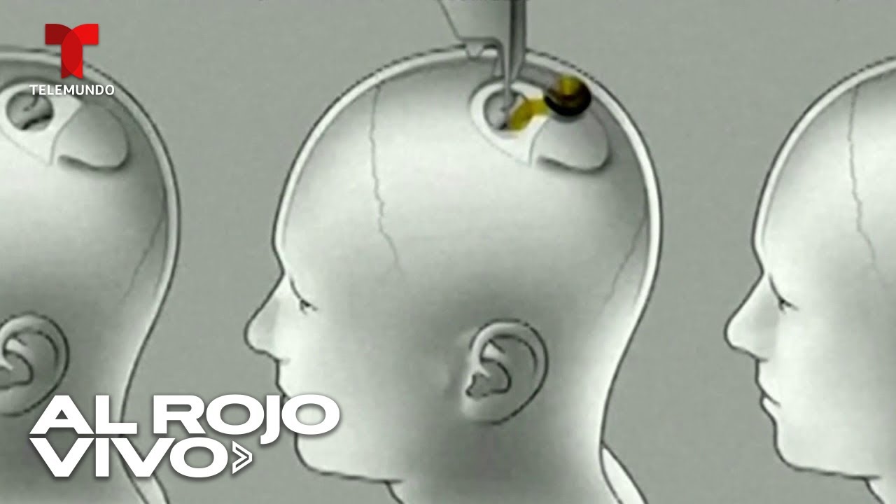 Elon Musk anuncia que iniciará ensayos de chips cerebrales en seres humanos