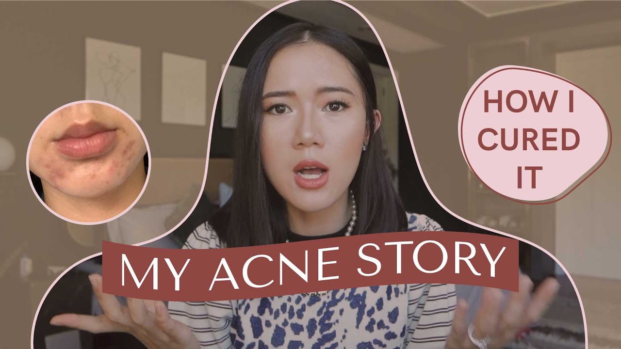 Worst Breakout Of My Life (How I Cured It) | Camille Co