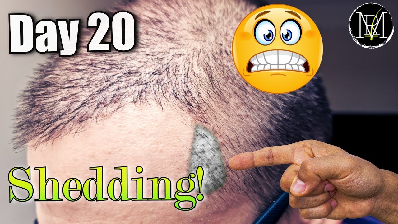 3 weeks after FUE/DHI Hair Transplant. My Experience.
