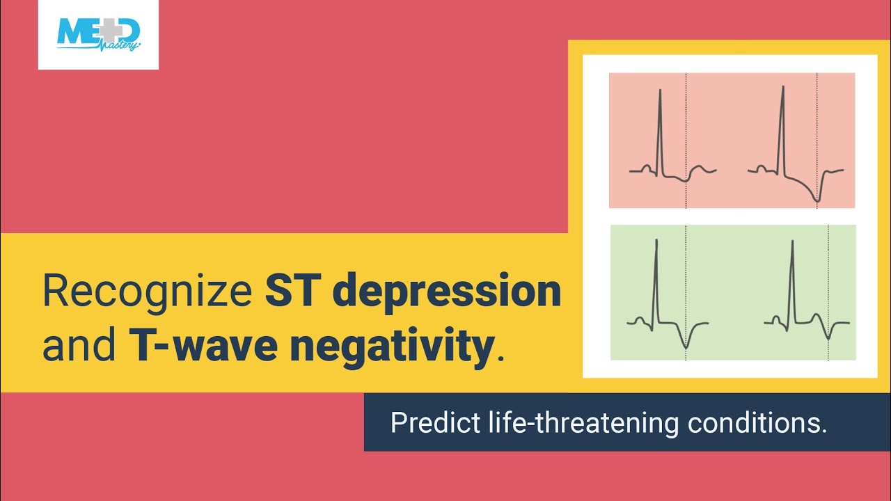 Simplifying ST depression and T-wave negativity
