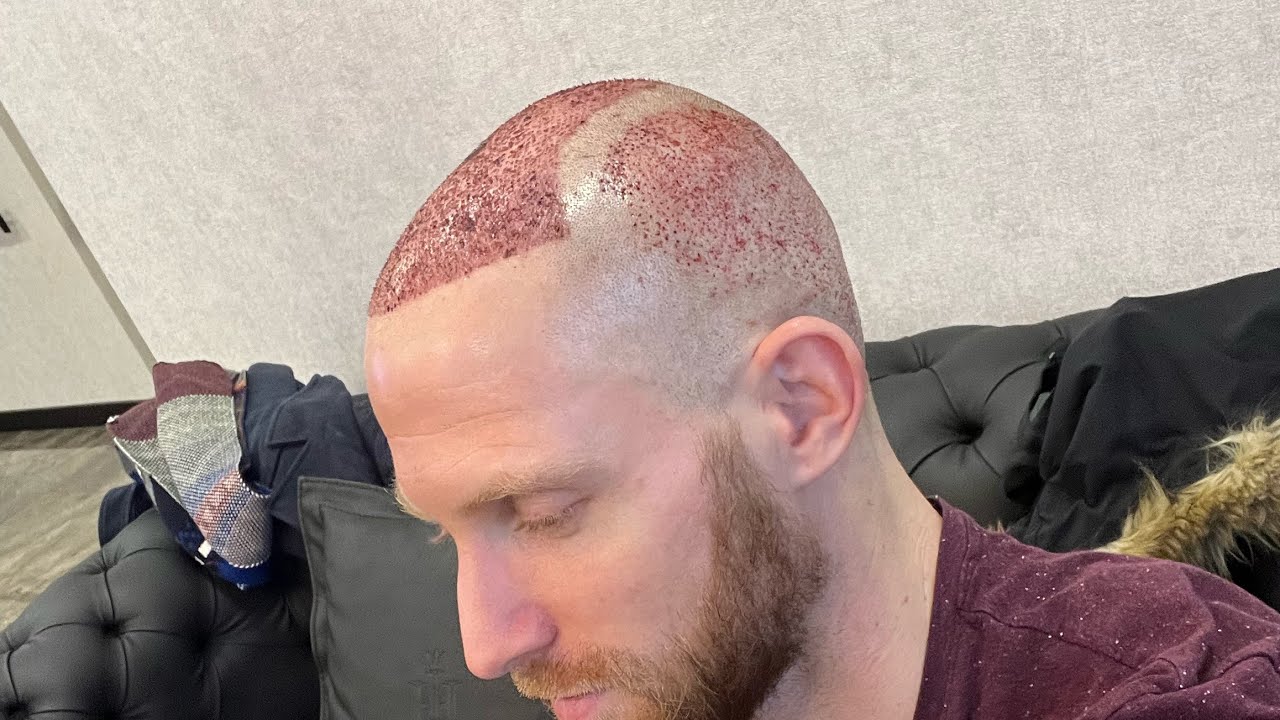 Implants Cheveux - 1 Mois APRÈS