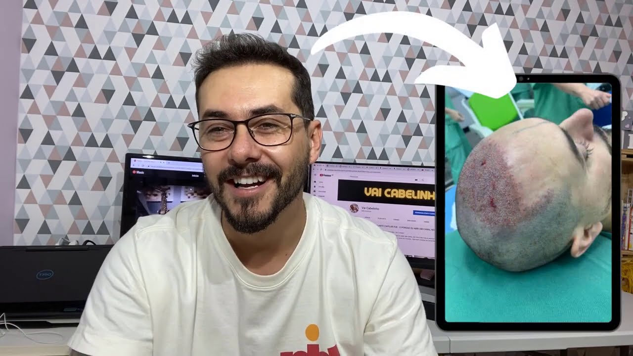 TRANSPLANTE CAPILAR FUE - EVOLUÇÃO MES A MES - 5 Meses | COVID  &  Ansiedade Pós Transplante Capilar