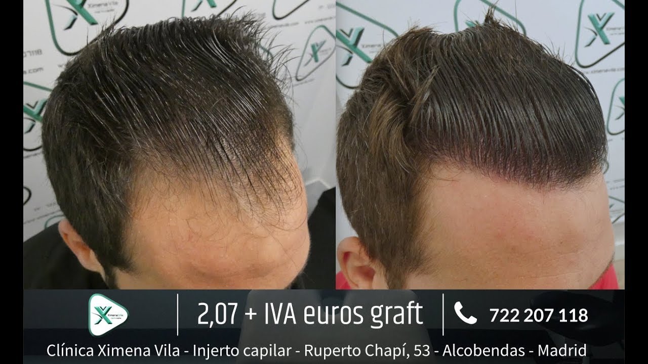 Trasplante capilar FUE - Hair transplant - Dra. Ximena Vila - 3003 Grafts