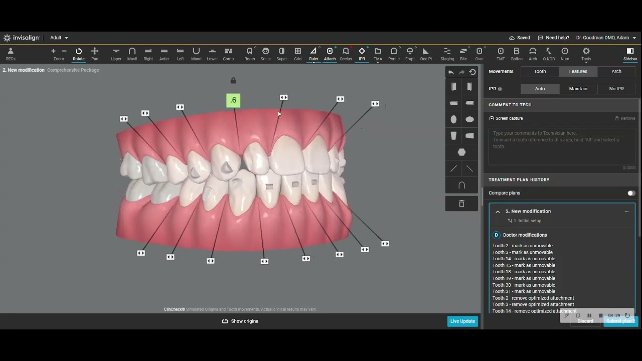 Leading Invisalign orthodontist shows some of his standard clincheck modifications