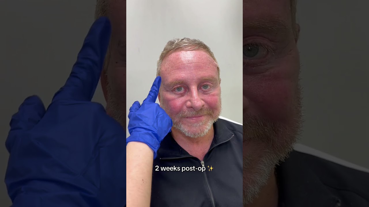 Best Male Facelift #nycmalefacelift #bestmalefacelift #faceliftnyc #malefacelift #faceliftnj