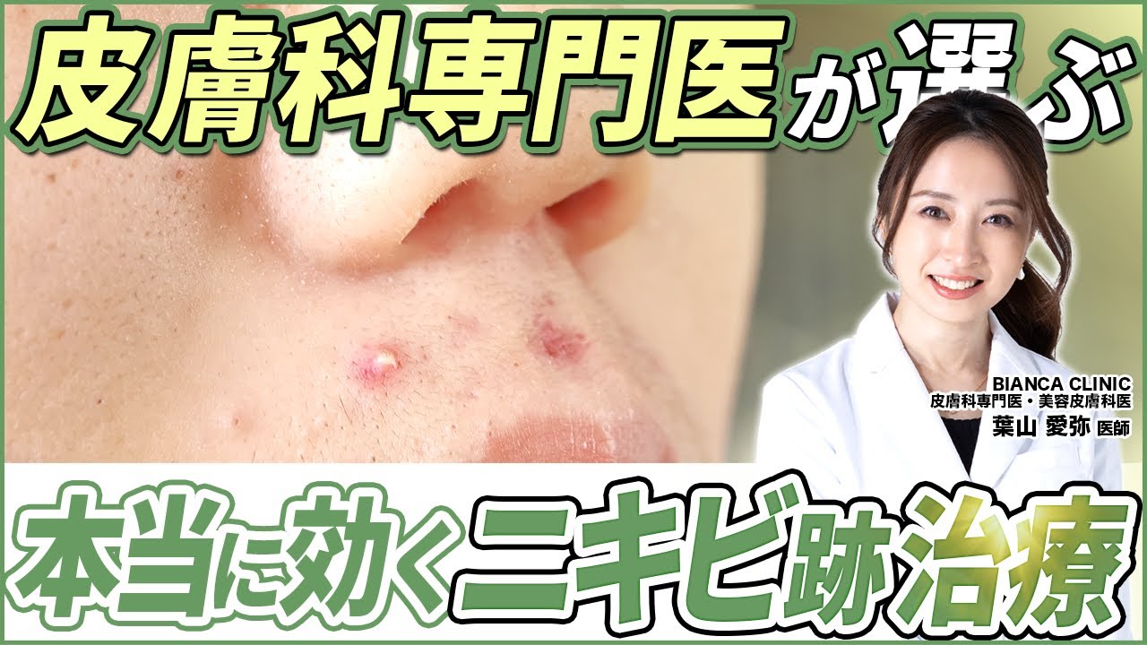 本気でニキビを治したい方へ知って欲しいニキビが出来る仕組みを皮膚科専門医がご説明します！