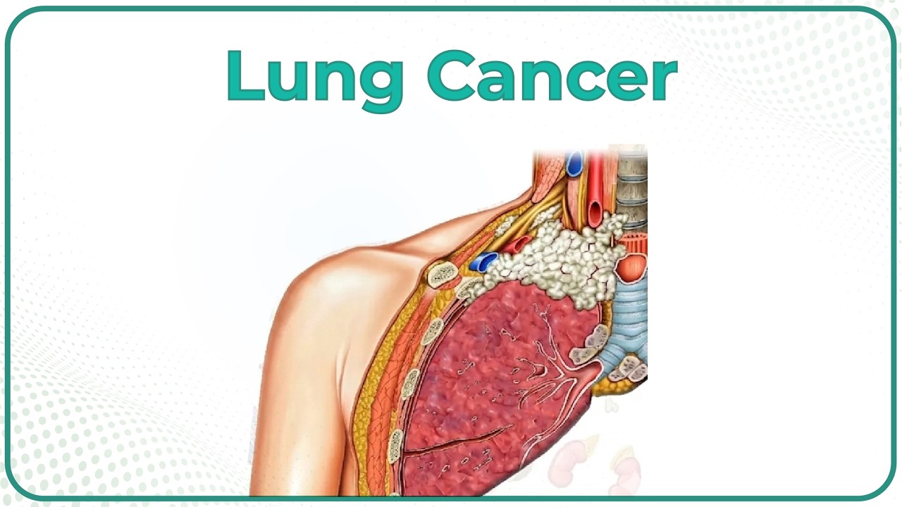 Lung Cancer / Pathology  - Squamous cell carcinoma #usmle #neetpg #fmge #mbbs