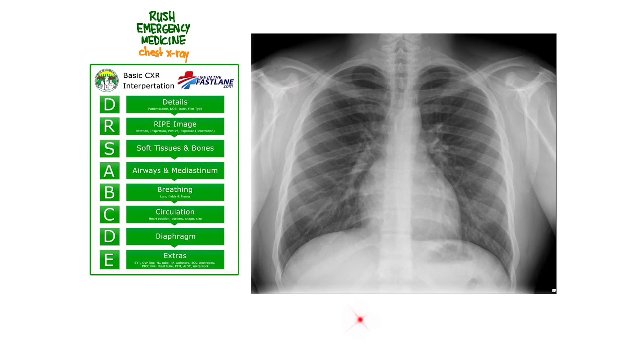 CXR a systematic approach