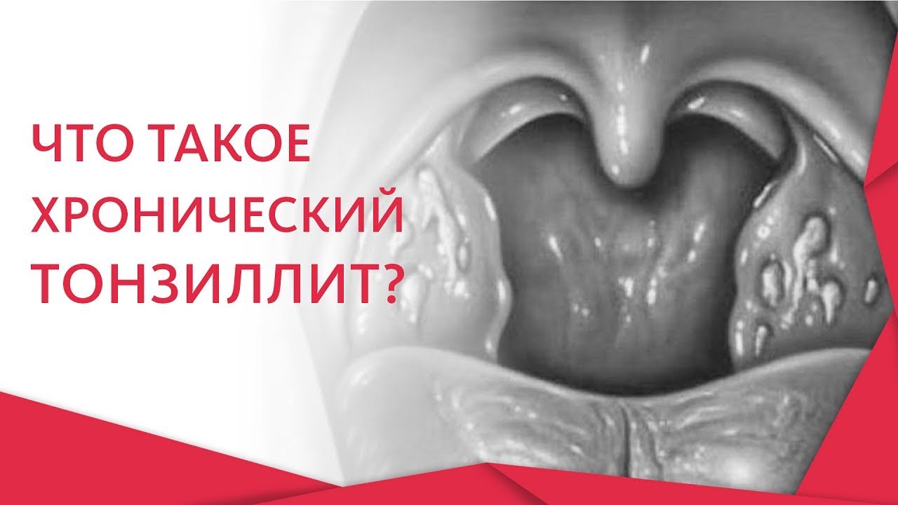 👏 Эффективные методы лечения хронического тонизиллита. Хронический тонзиллит лечение. 12+