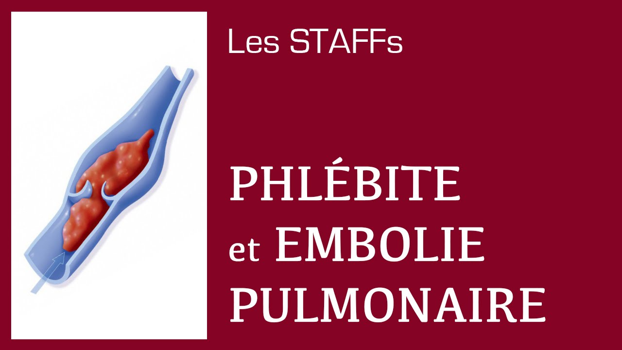Phlébite et Embolie pulmonaire - #12 - STAFFs Saint Camille