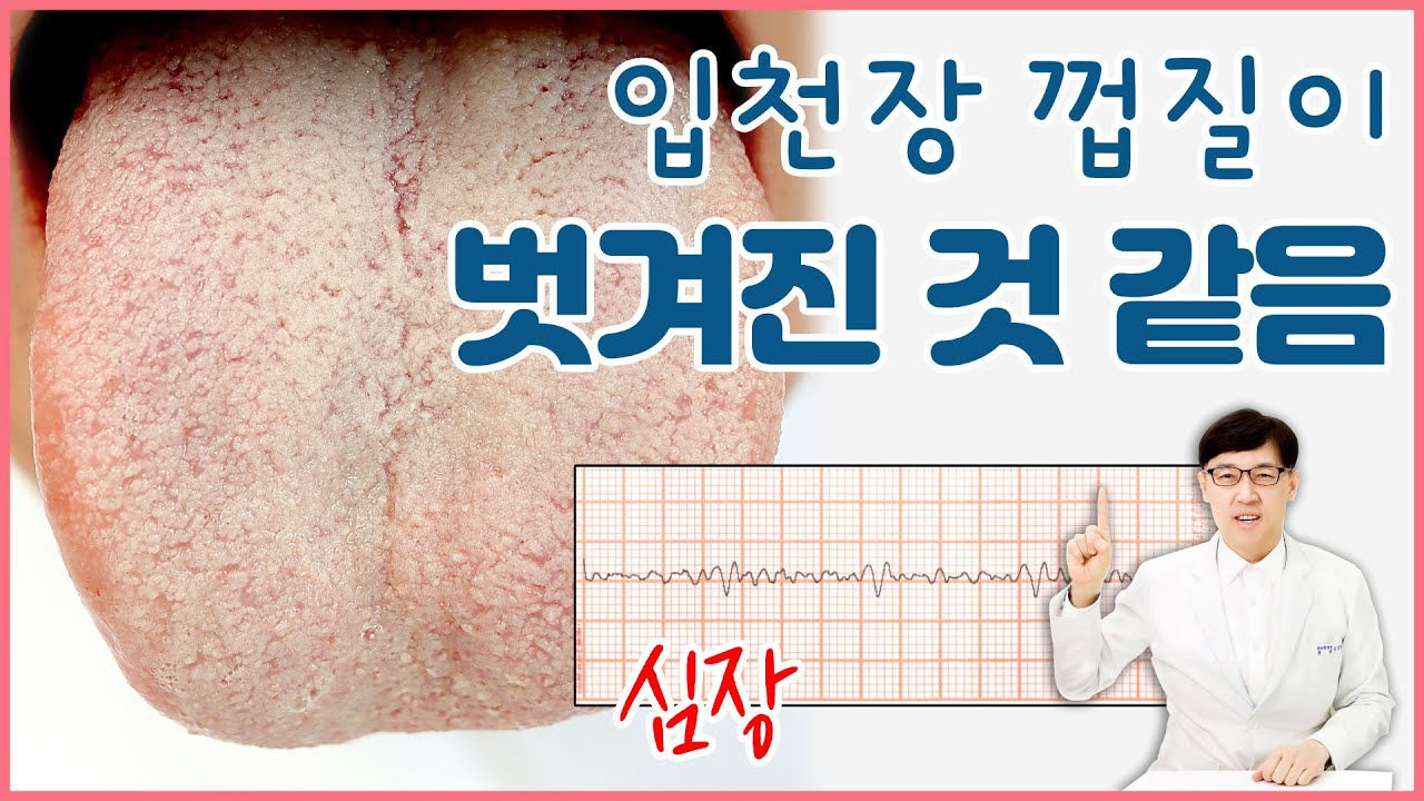 구강작열감증후군/ 입천장 껍질이 벗겨진 것처럼 아파요