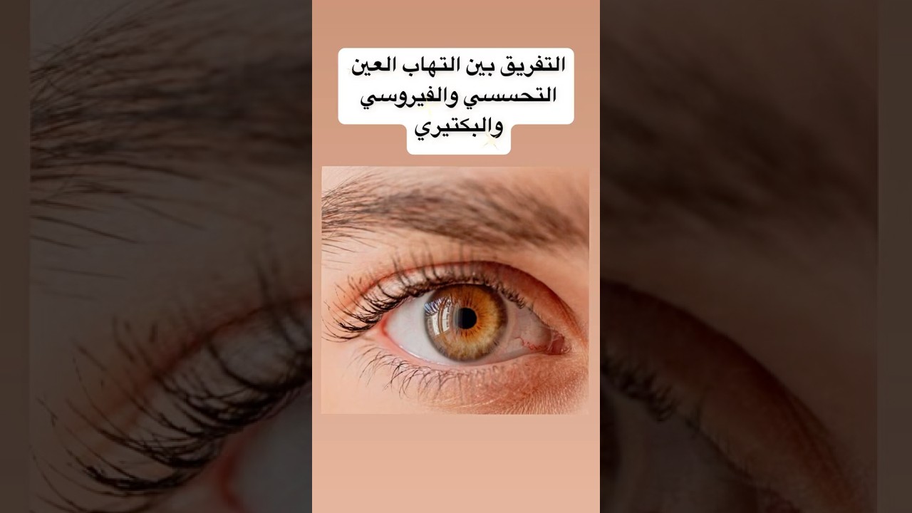 كيف نميز التهاب العين التحسسي من البكتيري والفايروسي ومتى لازم نشوف الطبيب #eyes #العين