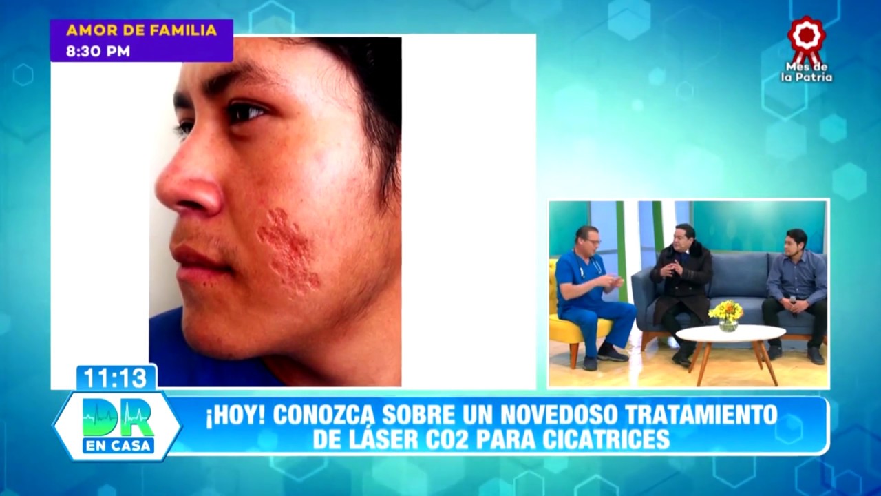Láser CO2 Fraccionado DEKA para Cicatrices - Entrevista Dr. Cesar Calderon Cirujano Plastico