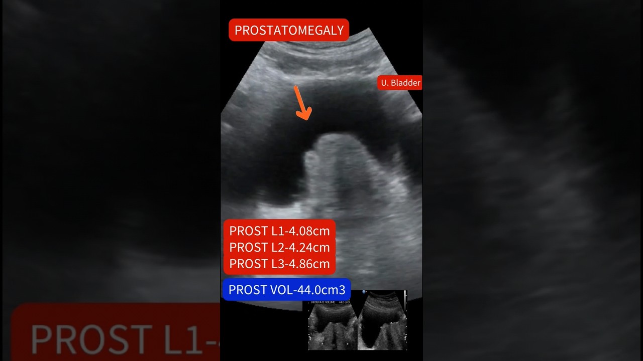 Ultrasound showing Enlarged prostate:prostatomegaly #ultrasound