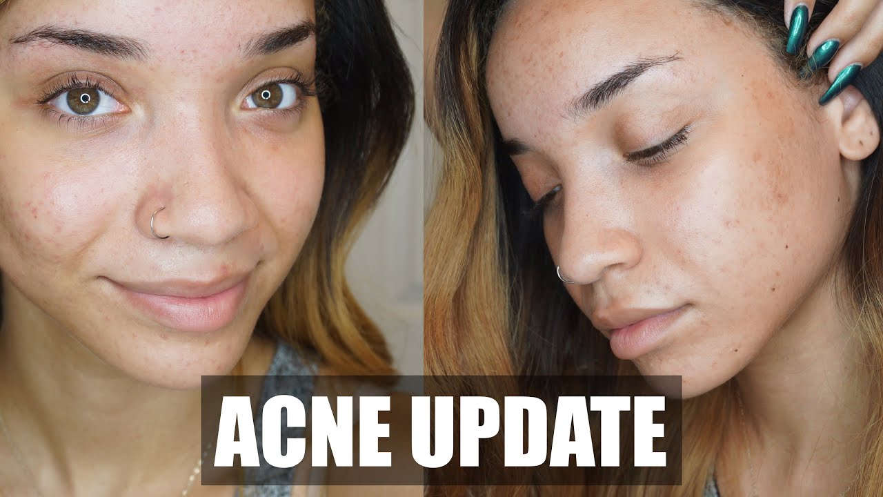 SKINCARE| Acne.org 6 Month Update