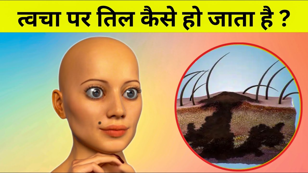 त्वचा पर तिल कैसे बनता हैं - formation of mole on skin