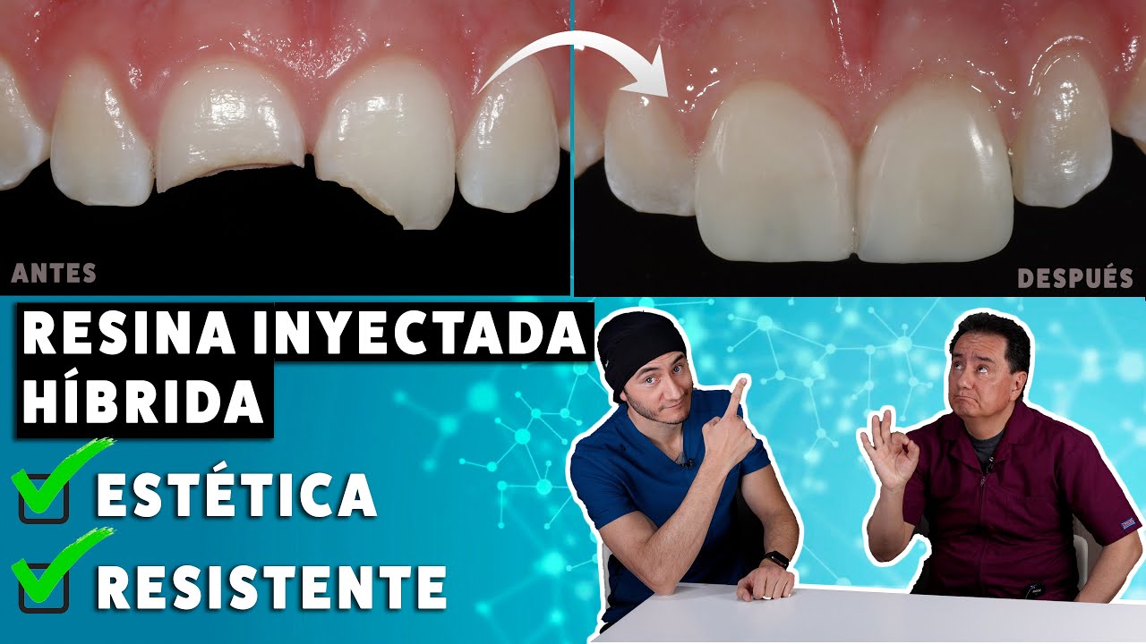 Carillas de Resina Inyectada Híbridas ¡Estéticas pero Resistentes! | Una excelente alternativa