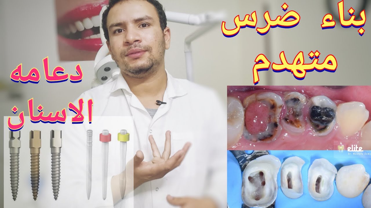 تكلفه تركيب دعامه للضرس المتهدم و متي ينصحك طبيب الاسنان بعملها