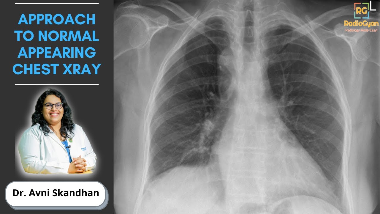 Approach to an Unremarkable Chest X-Ray | Dr. Avni Skandhan