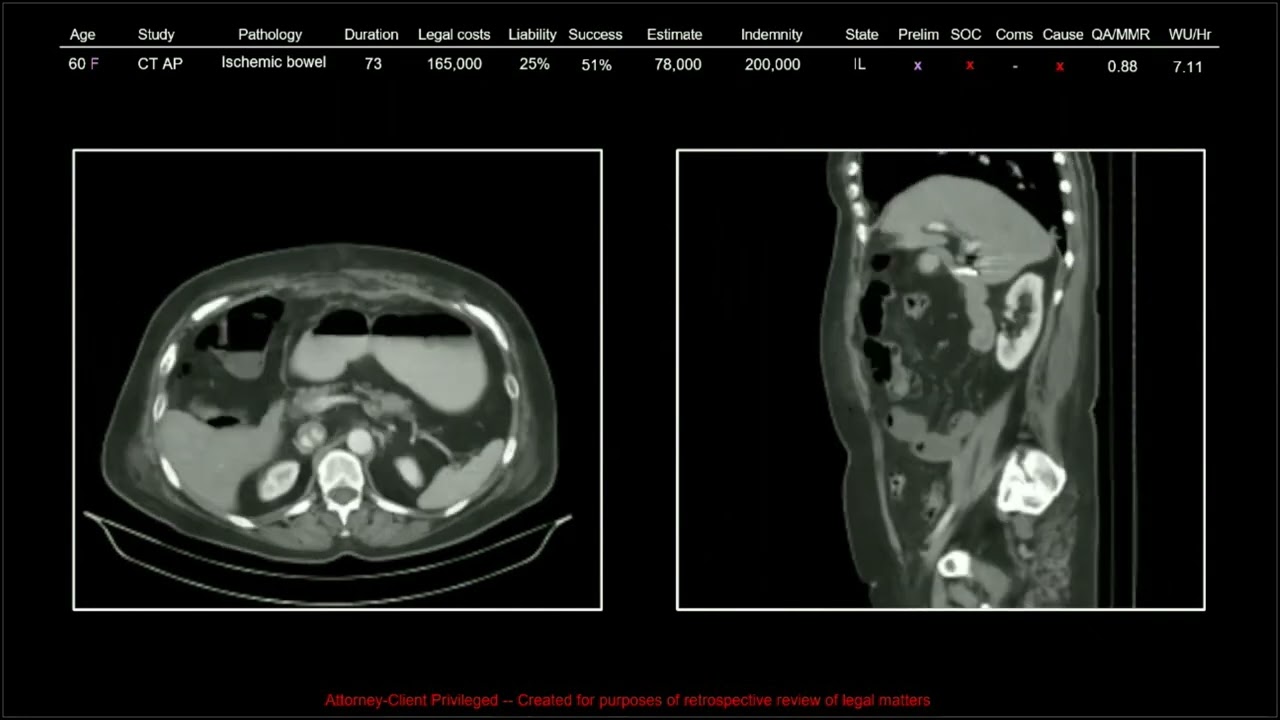 137 лет врачебной халатности. Часть 6 из 9 | Бесплатное непрерывное медицинское образование по ра...