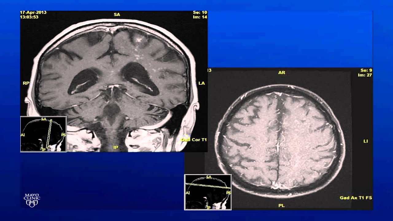 Unilateral Panuveitis