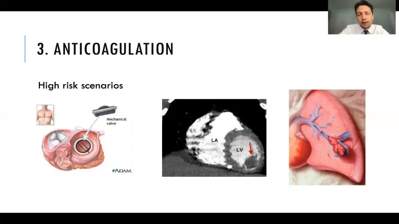 Dr. Dar Dowlatshahi - Restarting Antithrombotics in ICH