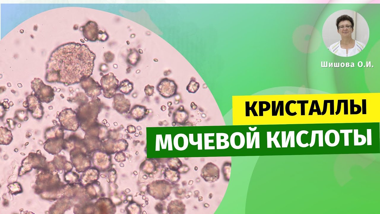 Про кристаллы, мочевой кислоты в нашем организме.
