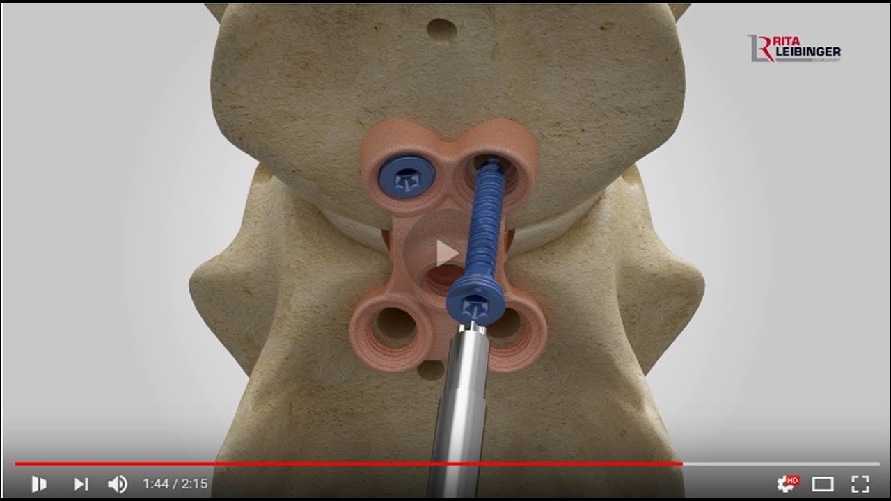 C-LOX - Spinal Surgery in Dogs - Disk Replacement - Wobbler Syndrome