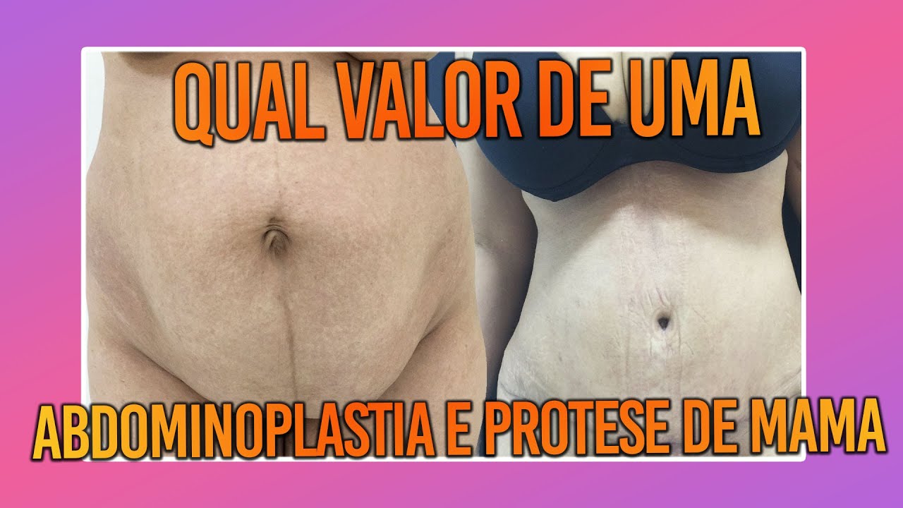 QUAL VALOR DE UMA ABDOMINOPLASTIA E PRÓTESE DE MAMA -  CIRURGIA PLÁSTICA