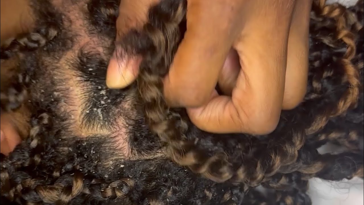 ASMR DANDRUFF SCRATCH & REMOVAL - finger nail scratch with light whispers