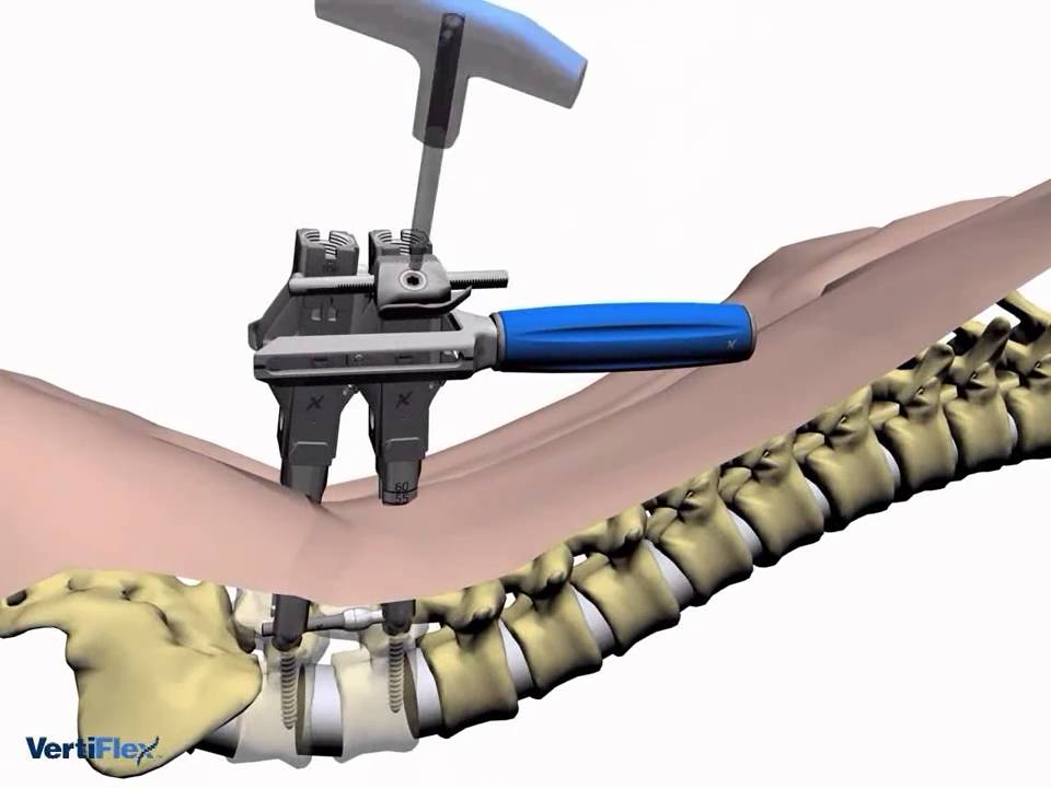 Perkutane minimalinvasive Versteifung der Lendenwirbelsäule