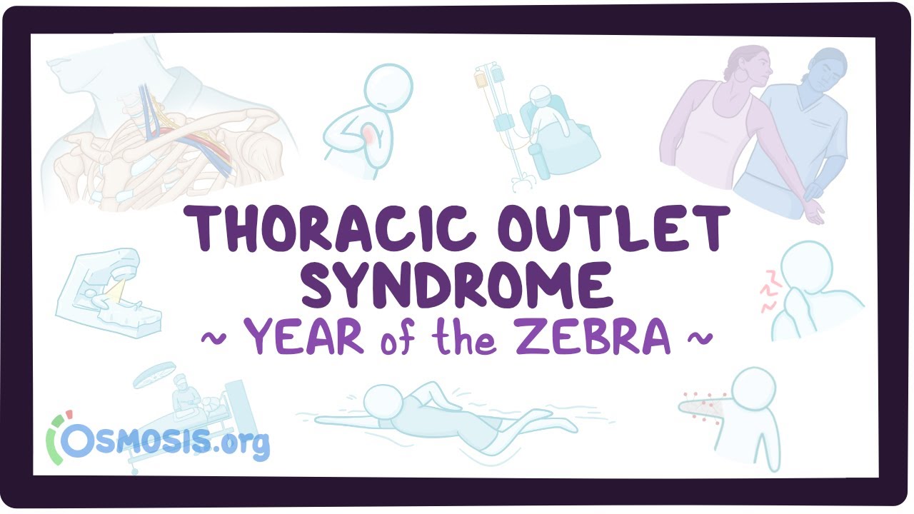 Thoracic outlet syndrome (Year of the Zebra)