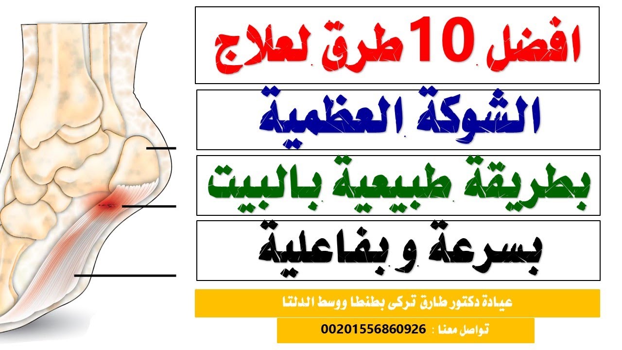 افضل 10 طرق طبيعية لعلاج الشوكة العظمية بالقدم بسرعة وبفاعلية بالمنزل نهائيا