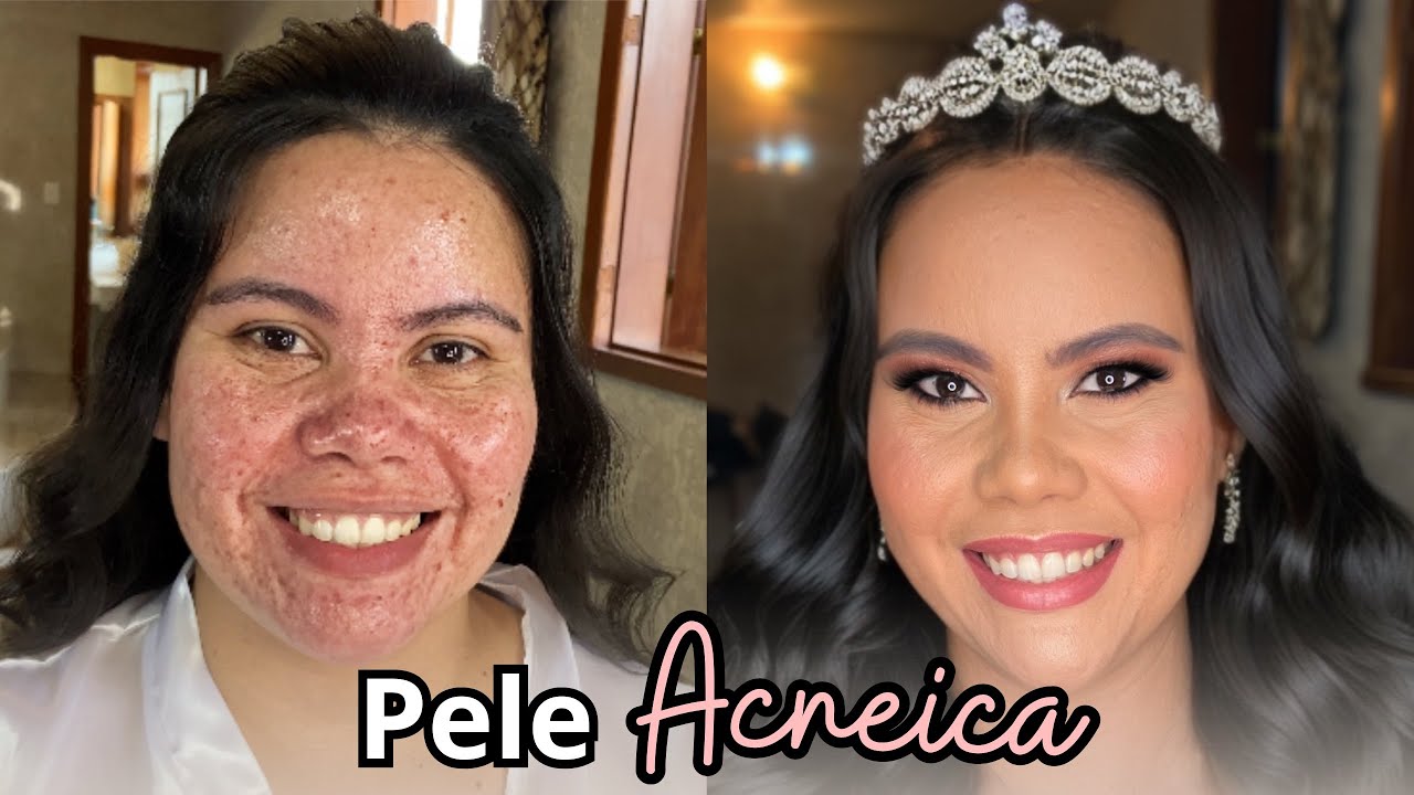 NOIVA DE PELE ACNEICA - Tutorial de como maquiar uma pele com Acne - Noiva de pele oleosa - NOIVAS