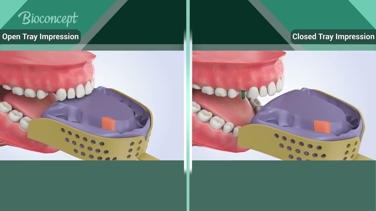 Bioconcept BV Implant Operations Step by Step