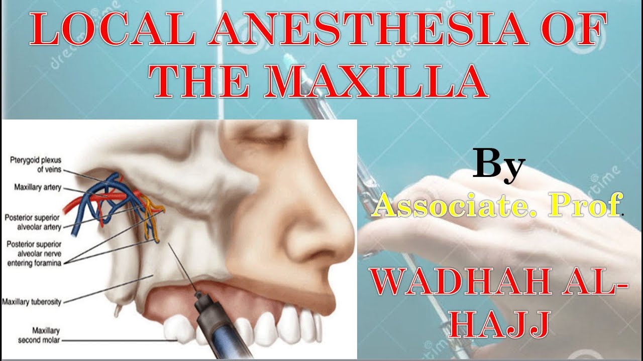 4- Local anesthesia of the maxilla – Dr Wadhah local anesthesia lectures.  د/ وضاح الحاج